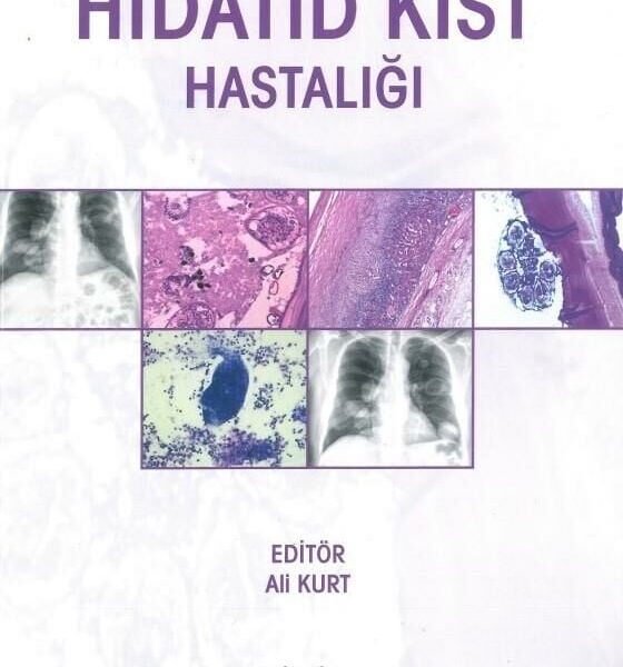 Hidatid Kist Hastalığı