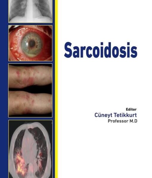 Sarcoidosis