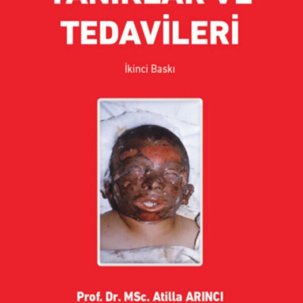 Yanıklar ve Tedavileri
