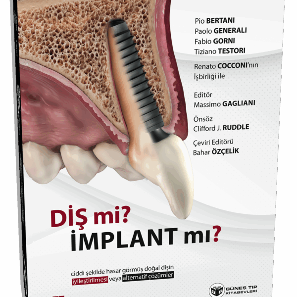 Diş mi? İmplant mı? (Doğal Dişin Korunması veya İmplant Çözümleri Üzerine Kapsamlı Rehber)