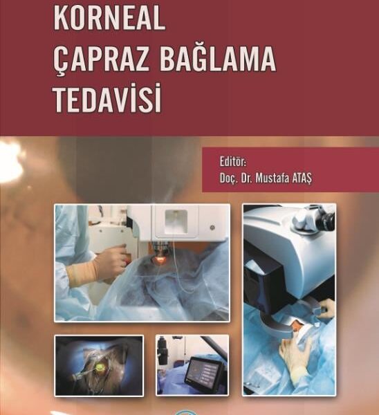 Korneal Çapraz Bağlanma Tedavisi