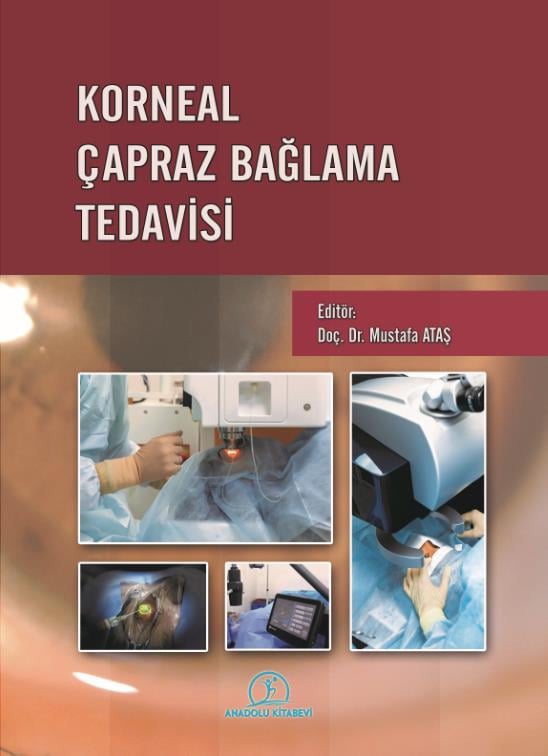 korneal-capraz-baglanma-tedavisi-3-329d.jpg