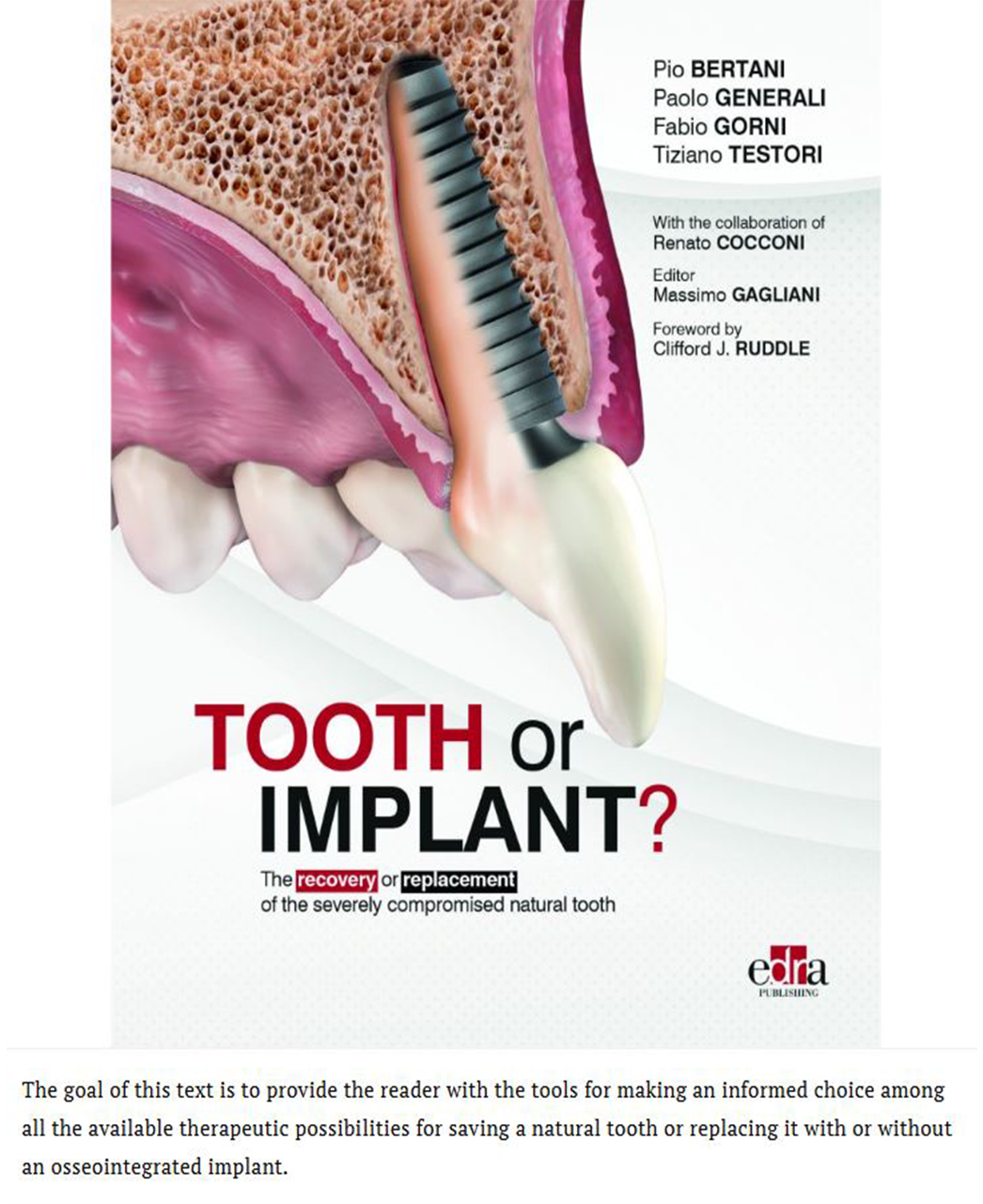 tooth-or-implant-b7-3b4.png