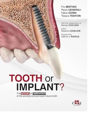 Tooth or Implant?: The recovery or replacement of the severely compromised natural tooth