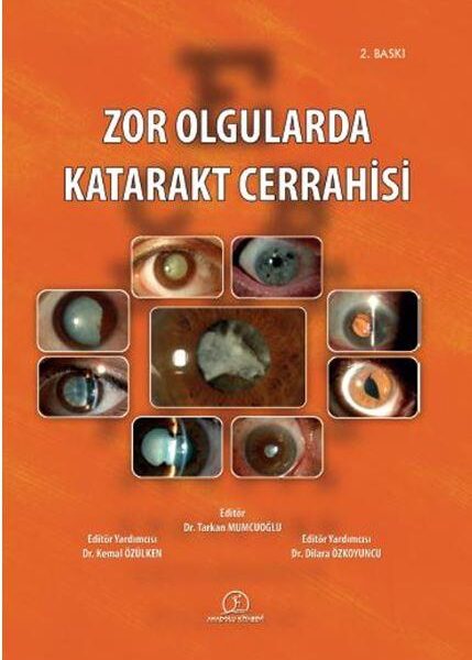 Zor Olgularda Katarakt Cerrahisi