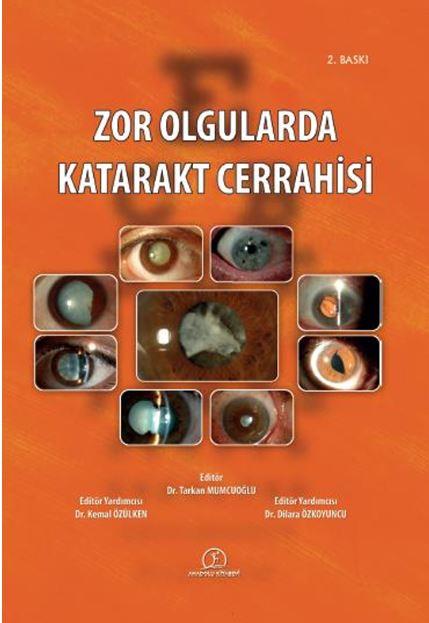 zor-olgularda-katarakt-cerrahisi-d01f7-.jpg
